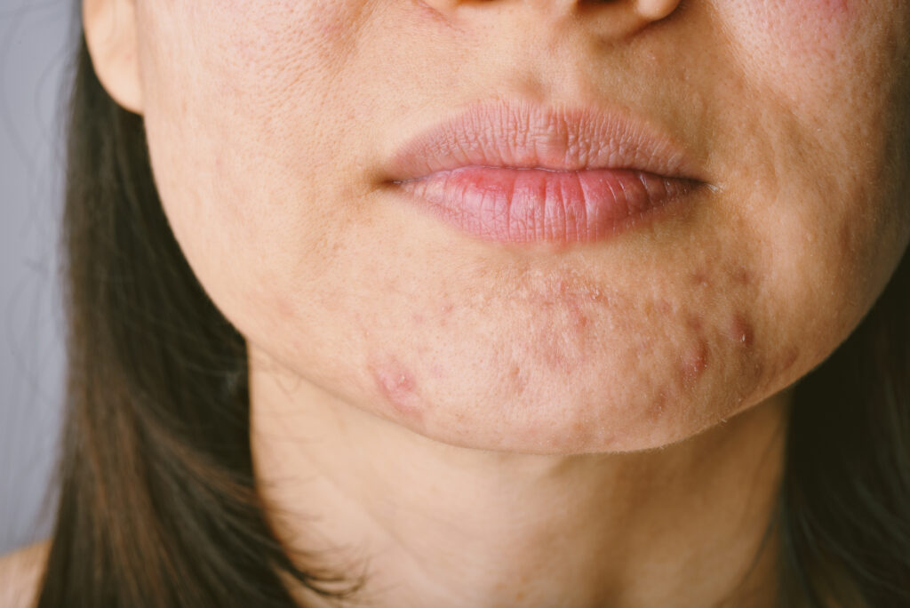Problema della pelle con malattie dell'acne, primo piano del viso di donna con brufoli bianchi sul mento, per indicare il trattamento di acne e rosacea.
