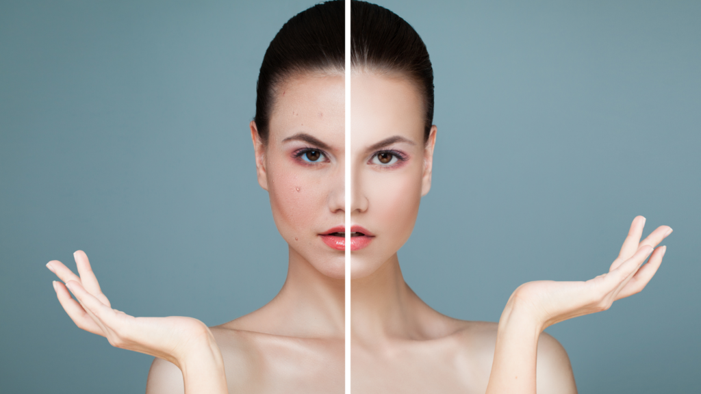 l'immagine raffigura una donna con il viso diviso a metà da una barra bianca: a sinistra, la pelle è affetta da acne e rosacea; a destra, la pelle è sana e luminosa, senza imperfezioni.