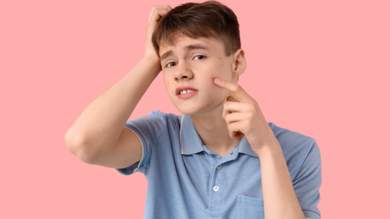 un giovane imbarazzato che si tocca il viso pieno di acne.